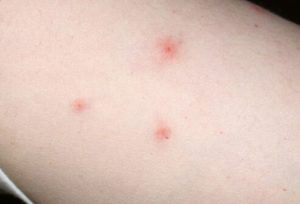 Bed Bug Bites - Sleep-Tite